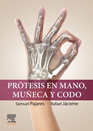 PRÓTESIS EN MANO, MUÑECA Y CODO