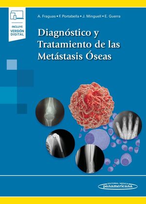 DIAGNÓSTICO Y TRATAMIENTO DE LAS METÁSTASIS ÓSEAS (INCLUYE VERSIÓN DIGITAL)