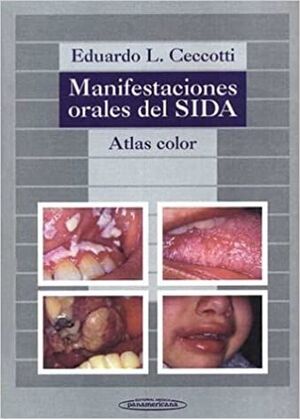 MANIFESTACIONES ORALES DEL SIDA. ATLAS COLOR